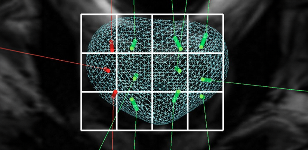 El ultrasonido 3D permite al médico adquirir instantáneamente toda la próstata del paciente