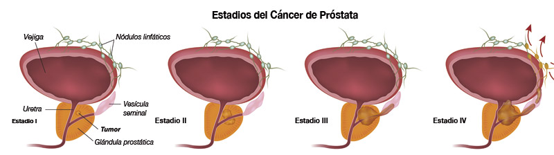 Estadios del Cáncer de Próstata
